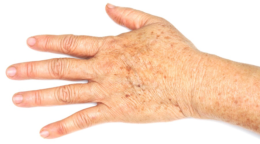 Aging Hands Medical Dermatology Inverness Dermatology Laser Birmingham Al