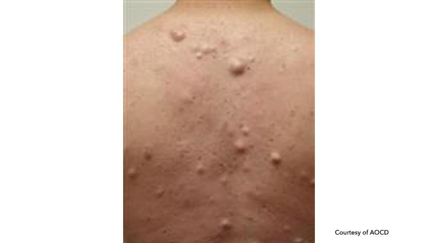 treatment-for-epidermoid-cysts-medical-dermatology-inverness