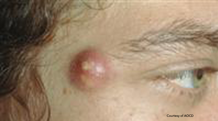 Treatment For Epidermoid Cysts Medical Dermatology Inverness Dermatology And Laser Birmingham Al 