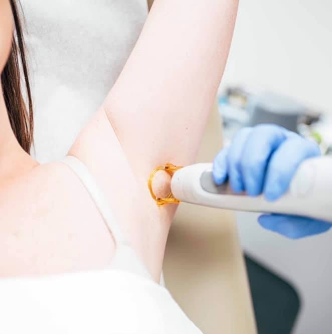 Laser Hair Removal