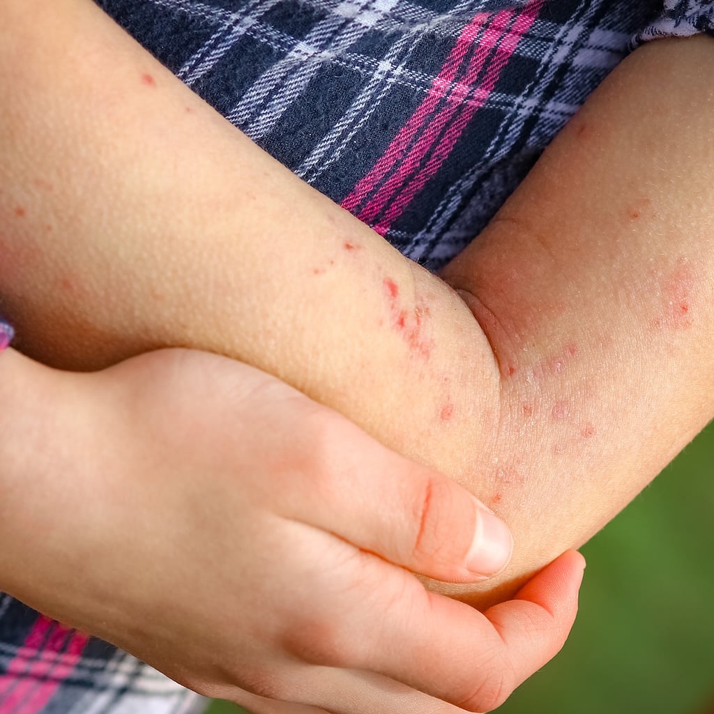 Contact Dermatitis