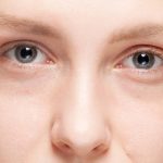 Restylane for Dark Circles Under Your Eyes