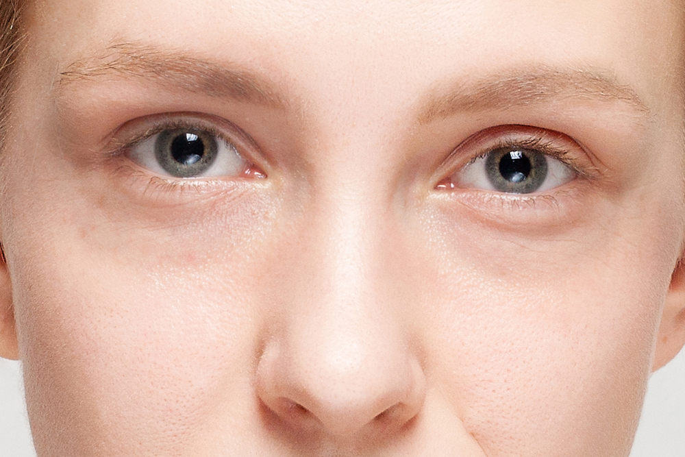 Restylane for Dark Circles Under Your Eyes