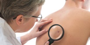 What to Do If You Notice a Suspicious Mole
