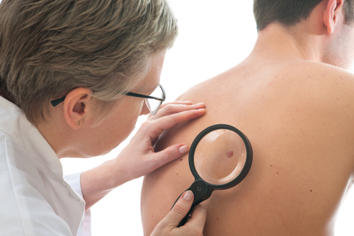 What to Do If You Notice a Suspicious Mole