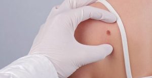Age Spots vs. Melanoma