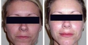 3 Signs You’re a Good Candidate for Microdermabrasion
