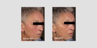 What is Photodynamic Therapy?