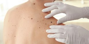 Skin Cancer Screening: What to Expect
