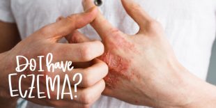 Do I Have Eczema?