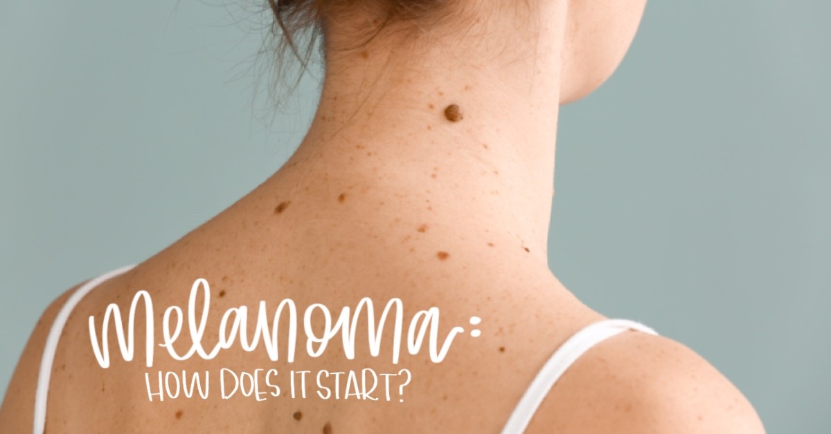 How Does Melanoma Start?