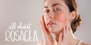 All About Rosacea