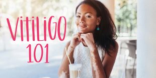 What is Vitiligo?