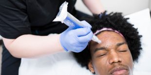 Microneedling